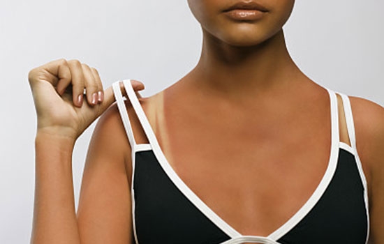 夏季皮肤晒伤的八个急救方法