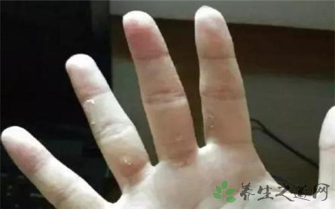 大拇指腱鞘炎怎么按摩